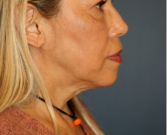 Feel Beautiful - Necklift 206 - Before Photo